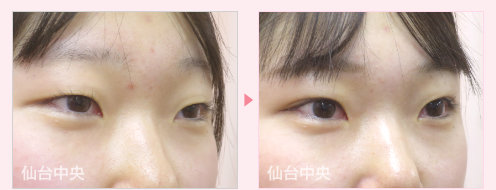 二重埋没法 症例写真 - 術前と術後13日目の比較、右向き