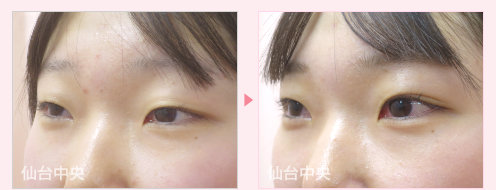 二重埋没法 症例写真 - 術前と術後13日目の比較、左向き