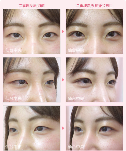 二重埋没法 症例写真