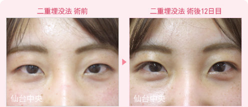 二重埋没法症例写真 - 術前と術後12日目の比較、正面