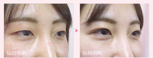 二重埋没法症例写真 - 術前と術後12日目の比較、右向き