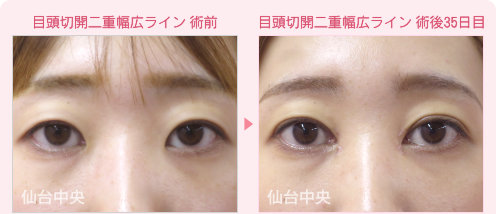 目頭切開、二重埋没法手術症例写真 - 術前と術後35日目の比較、正面