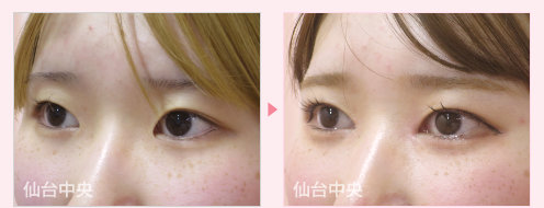 目頭切開、二重埋没法手術症例写真 - 術前と術後48日目の比較、左向き