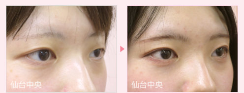 二重左右差修正 症例写真 - 術前と術後224日目の比較、右向き