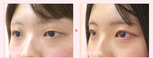 二重左右差修正 症例写真 - 術前と術後224日目の比較、左向き