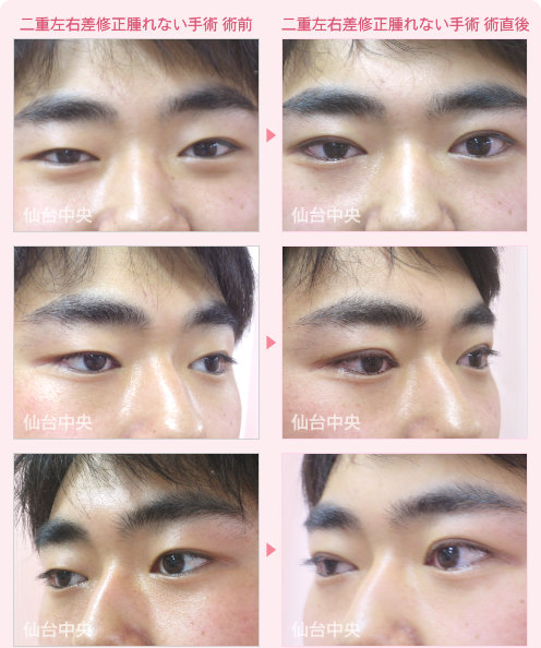 二重左右差修正腫れない手術 症例写真