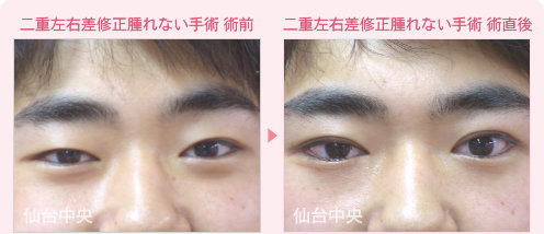 二重左右差修正、腫れない二重手術 症例写真 - 術前と術直後の比較、正面