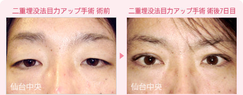 上眼瞼弛み取り目力アップ手術 症例写真