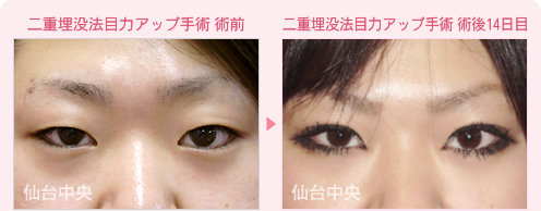 二重埋没法目力アップ手術 症例写真