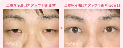 二重埋没法目力アップ手術 症例写真