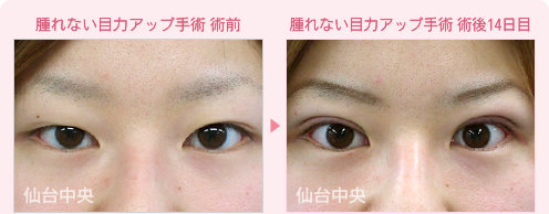 腫れない目力アップ手術 症例写真