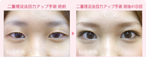 二重埋没法目力アップ手術 症例写真