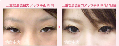 二重埋没法目力アップ手術 症例写真