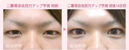 二重埋没法目力アップ手術 症例写真