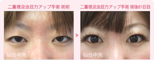 二重埋没法目力アップ手術 症例写真