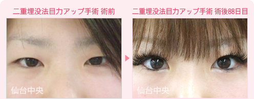 二重埋没法目力アップ手術 症例写真
