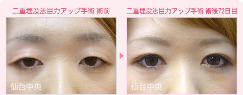 二重埋没法目力アップ手術 症例写真