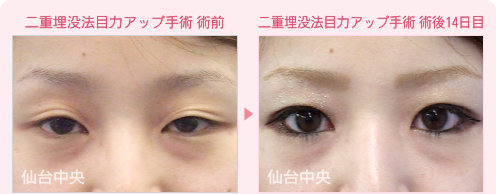 二重埋没法目力アップ手術 症例写真