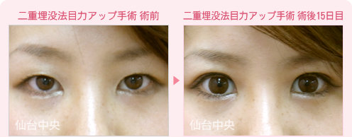 二重埋没法目力アップ手術 症例写真