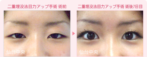 二重埋没法目力アップ手術 症例写真