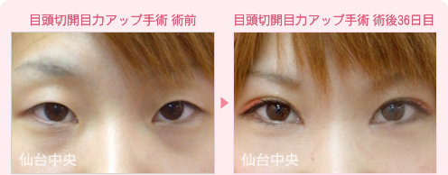 目頭切開目力アップ手術 症例写真