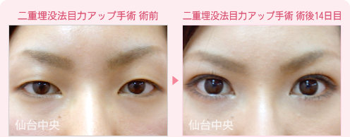 二重埋没法目力アップ手術 症例写真