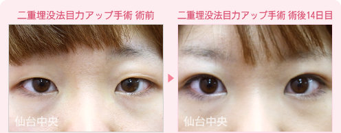 二重埋没法目力アップ手術 症例写真