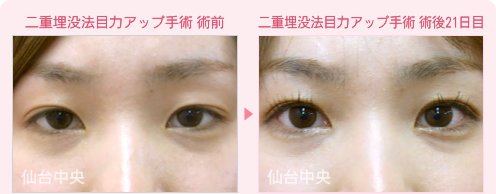 二重埋没法目力アップ手術 症例写真