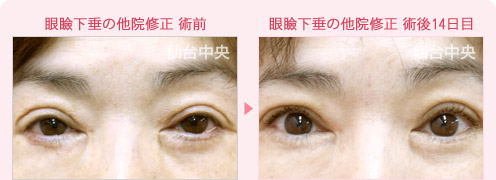 眼瞼下垂の他院修正