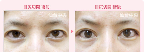 目尻切開