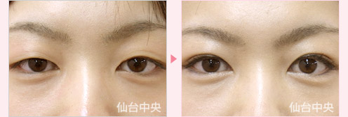 二重埋没法