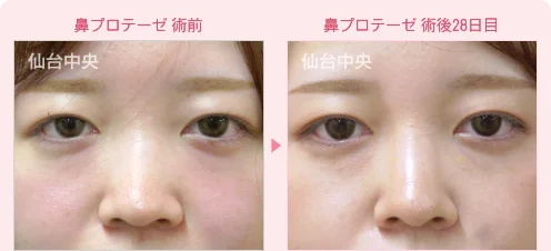 鼻プロテーゼ 症例写真1