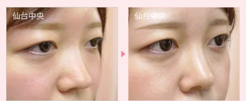 鼻プロテーゼ 症例写真2