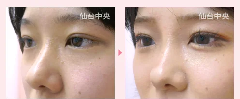 鼻ヒアルロン酸注射 症例写真3