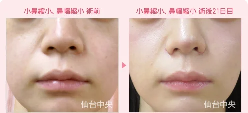 小鼻縮小 鼻幅縮小 症例写真1