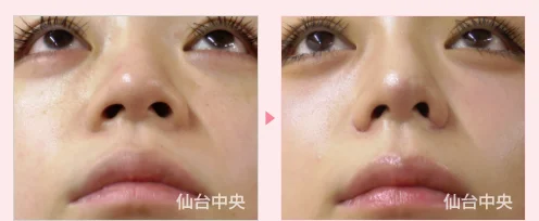 小鼻縮小 鼻幅縮小 症例写真2