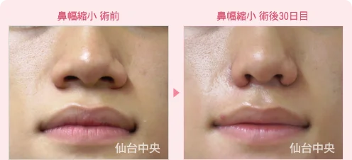 鼻幅縮小 症例写真1