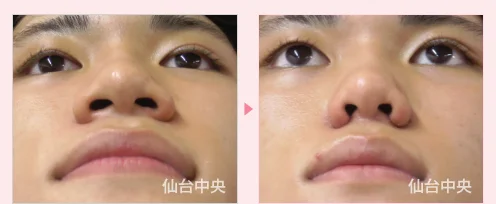 鼻幅縮小 症例写真2