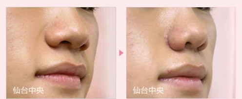 鼻幅縮小 症例写真2