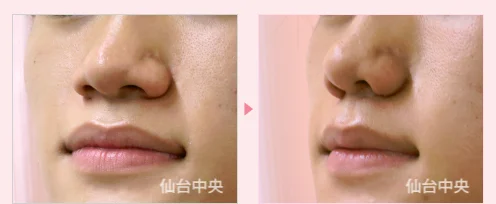 鼻幅縮小 症例写真2