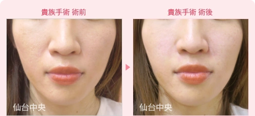 貴族手術 症例写真1