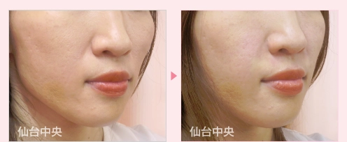 貴族手術 症例写真2