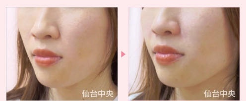 貴族手術 症例写真3