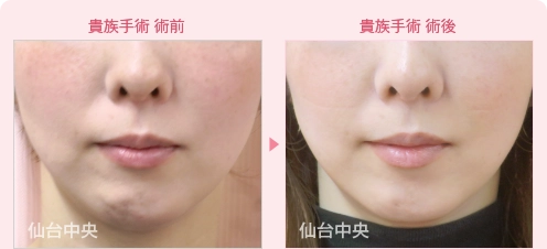 貴族手術 症例写真1