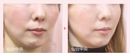 貴族手術 症例写真2