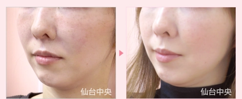 貴族手術 症例写真3