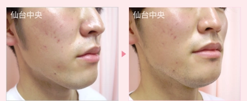 あご削り 症例写真2