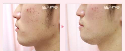 あご削り 症例写真5