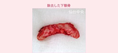 除去した下顎骨