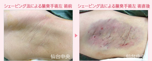 シェービング法による腋臭手術左